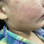 Image of measles rash