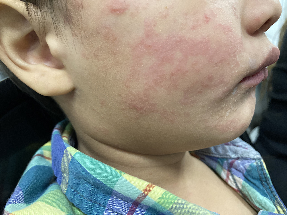 Image of measles rash