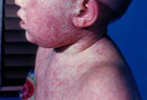 Photo of boy with measles rash