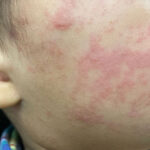Measles Rash